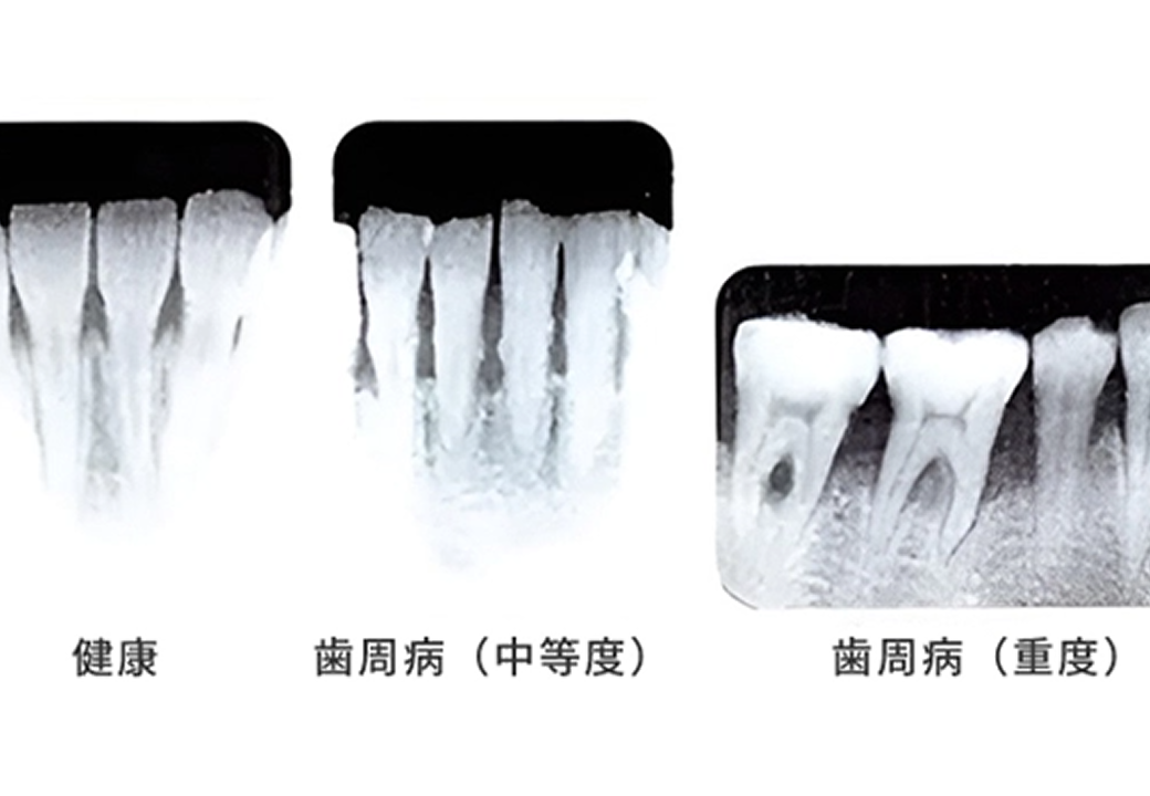 歯周病の検査